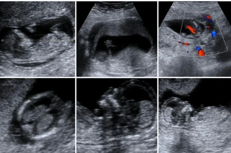 Fetal Color Doppler